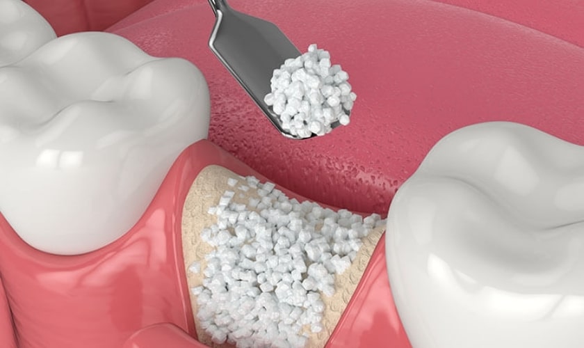 How Long Does it Take for Dental Bone Graft to Heal