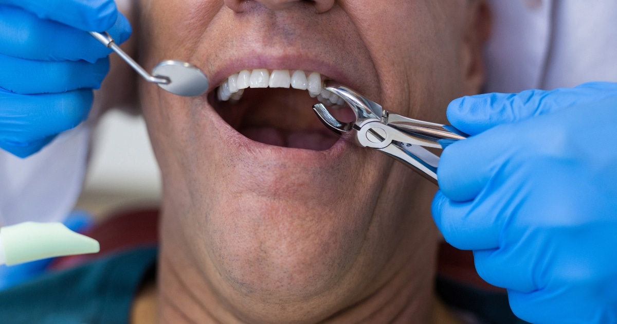 how to control bleeding after tooth extraction in cypress