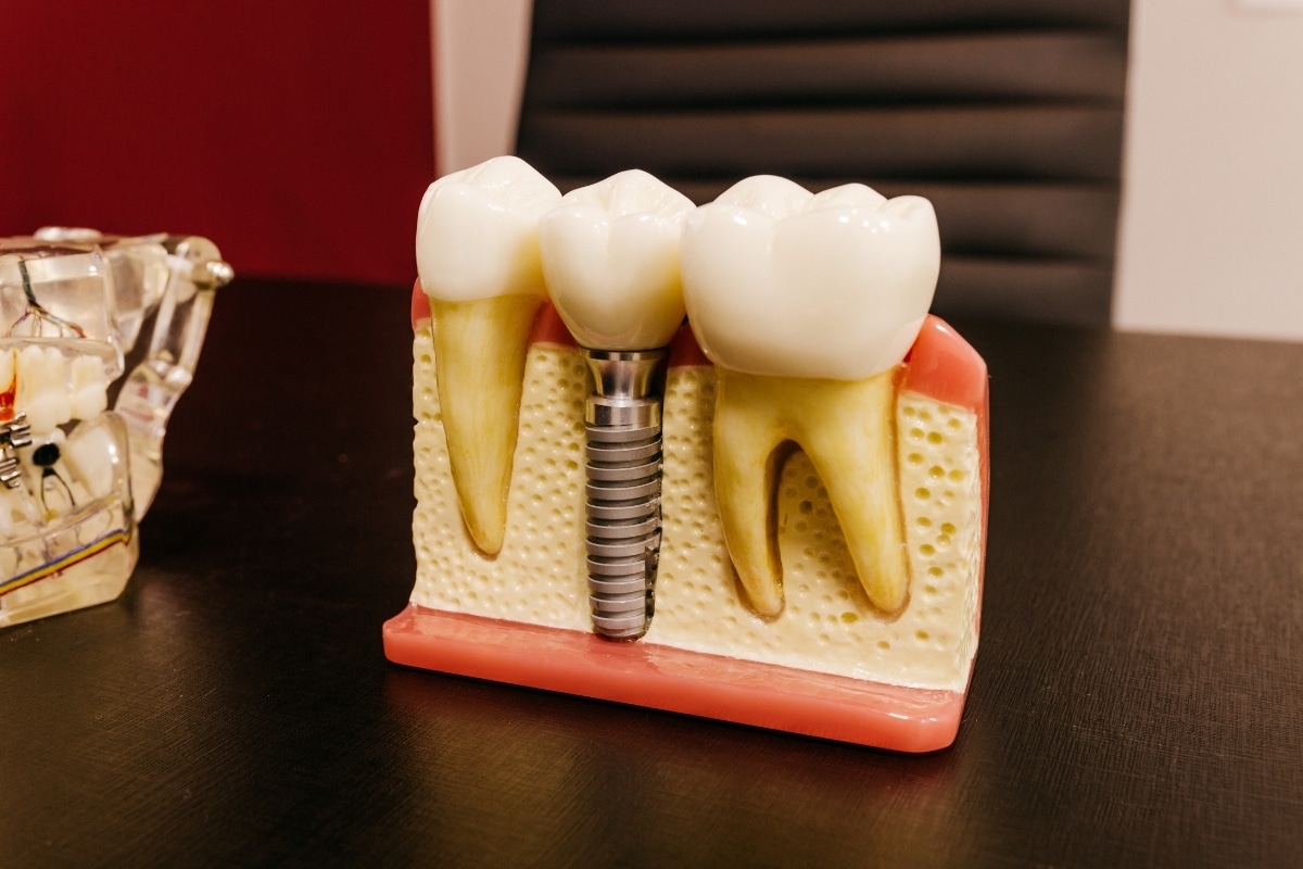 dental implants in Cypress
